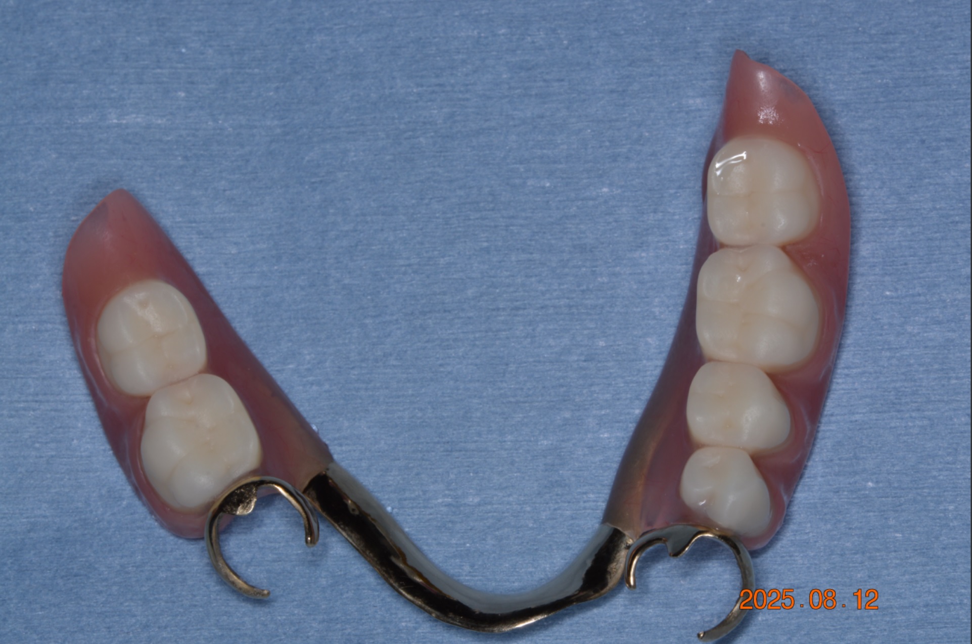 にわ歯科室の部分入れ歯