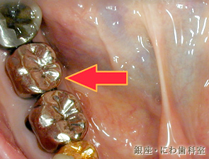 健康保険の全部被せ物