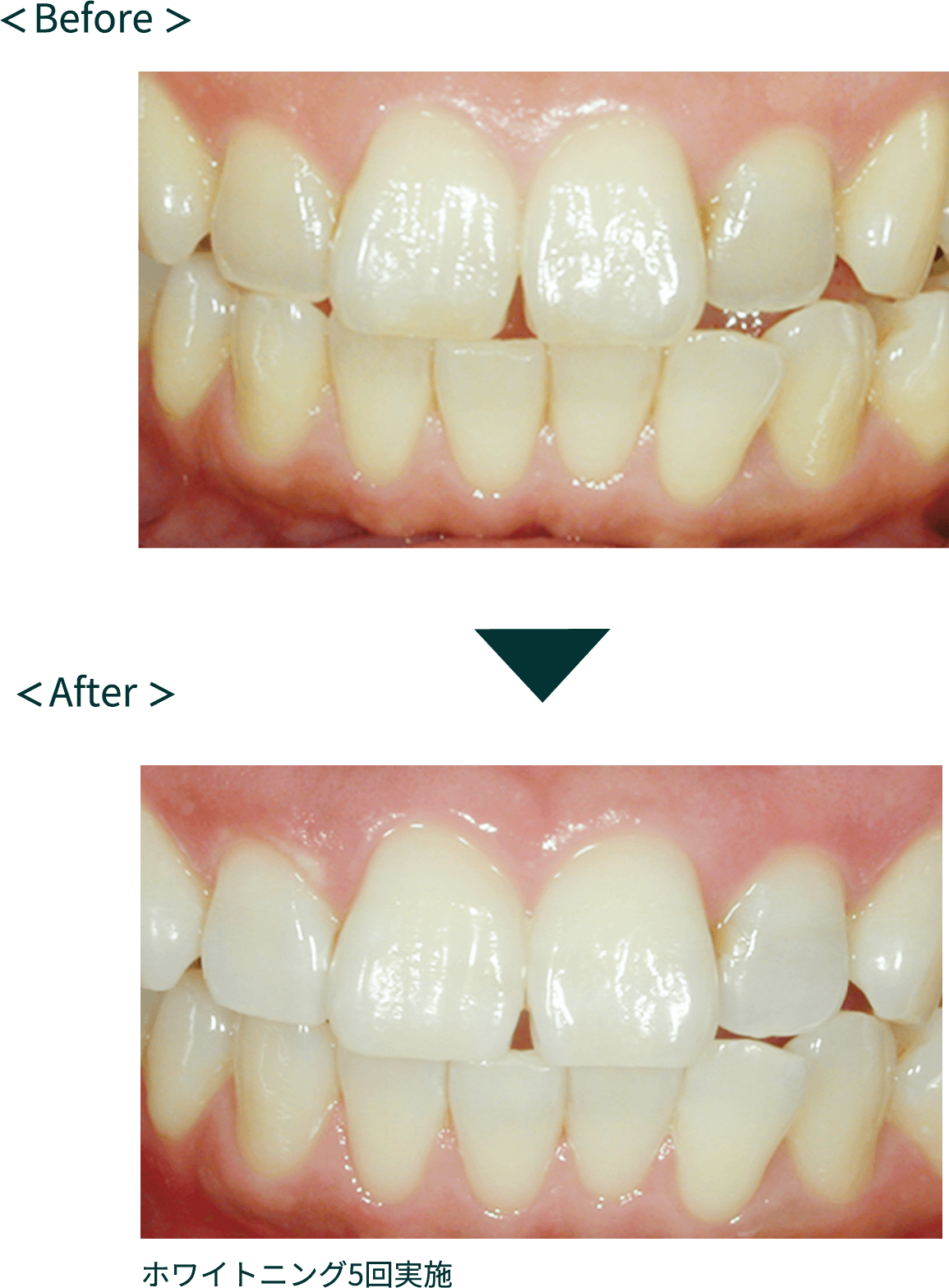 ホワイトニングビフォーアフター写真